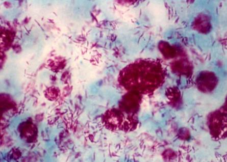 ?海分枝桿菌感染患者集中在哪里？?海分枝桿菌毒性大嗎