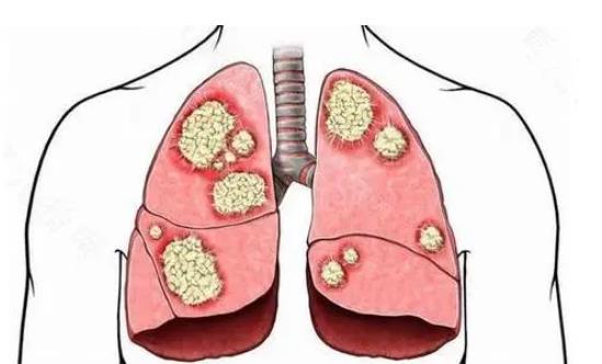 生長(zhǎng)抑制因子5（ING5）對(duì)肺癌細(xì)胞的抑制作用（一）
