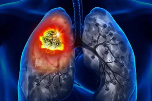 生長(zhǎng)抑制因子5（ING5）對(duì)肺癌細(xì)胞的抑制作用（二） 