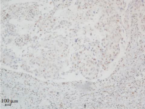 CLDN10信號通路對膀胱癌細(xì)胞生長和增殖的作用（三）